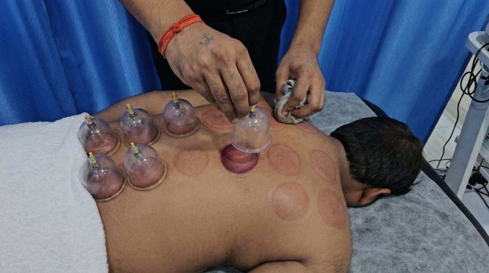 Cupping Therapy Session