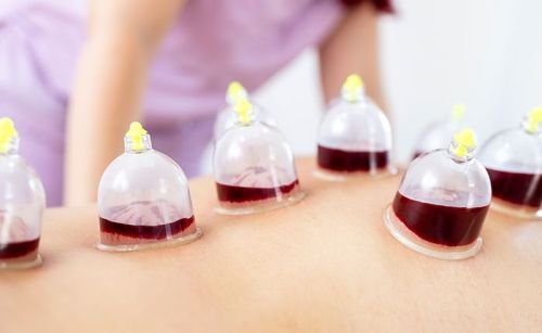 Wet cupping therapy noida extension vacucare wellness center