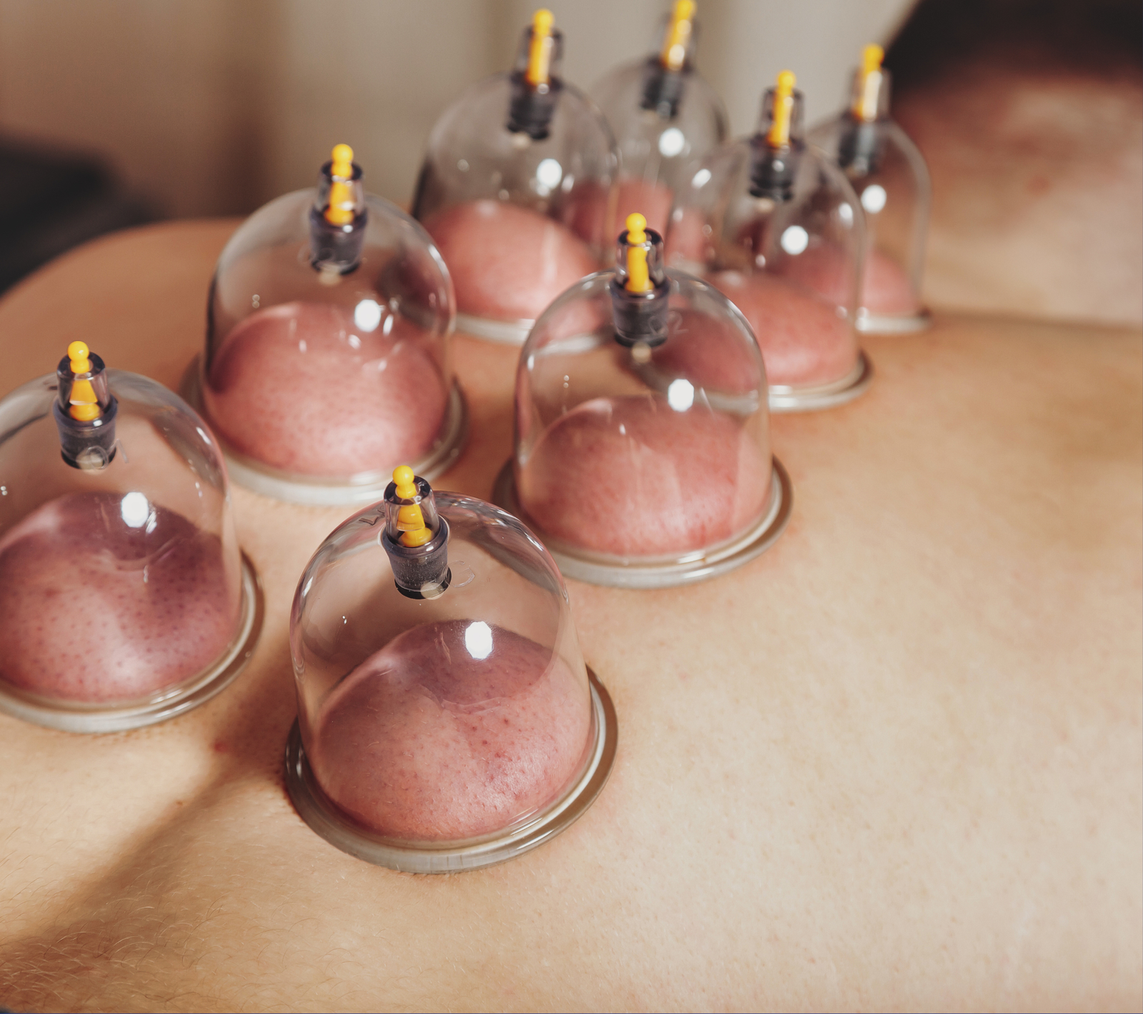 dry Cupping in noida extension