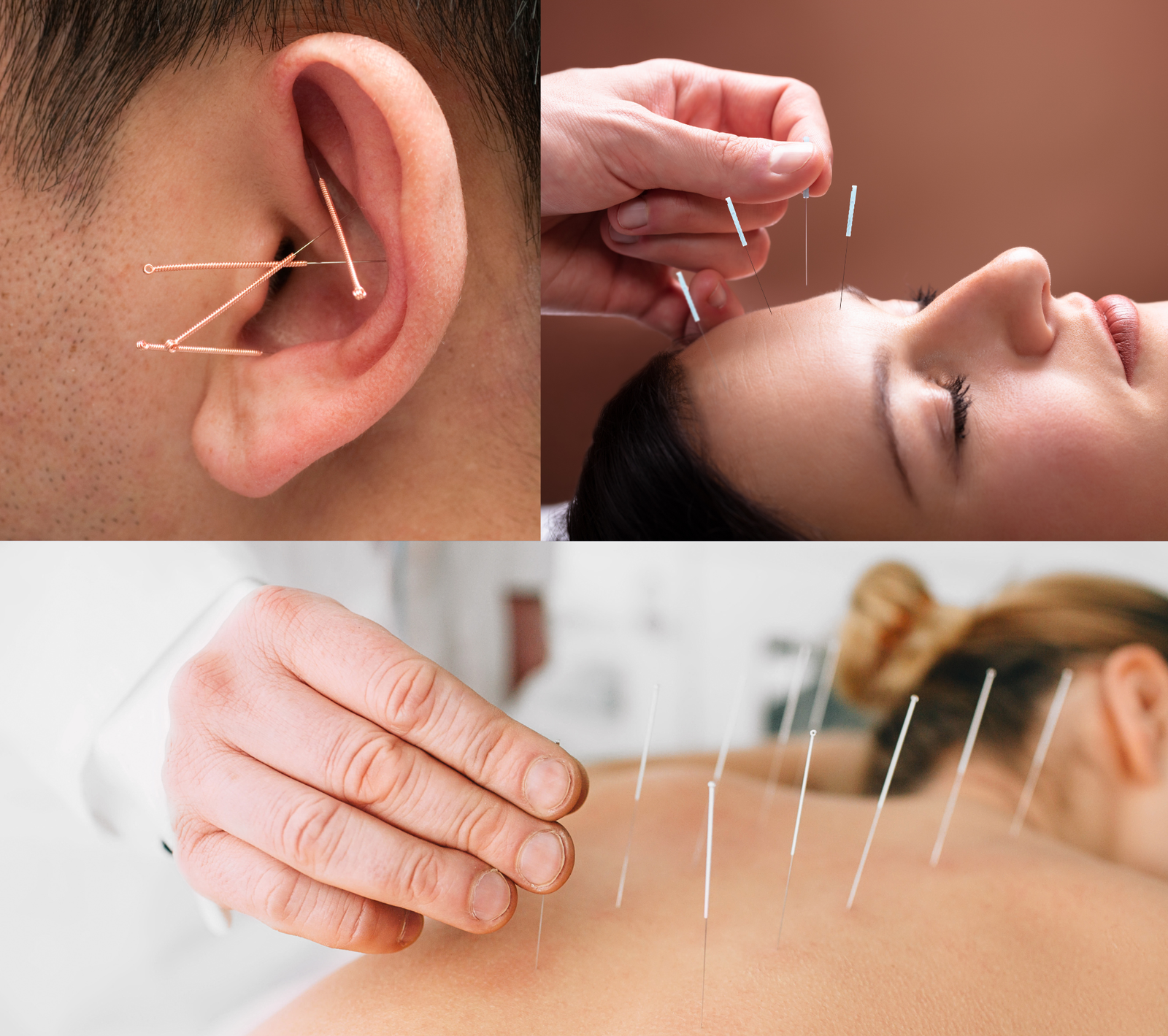 Acupuncture therapy center