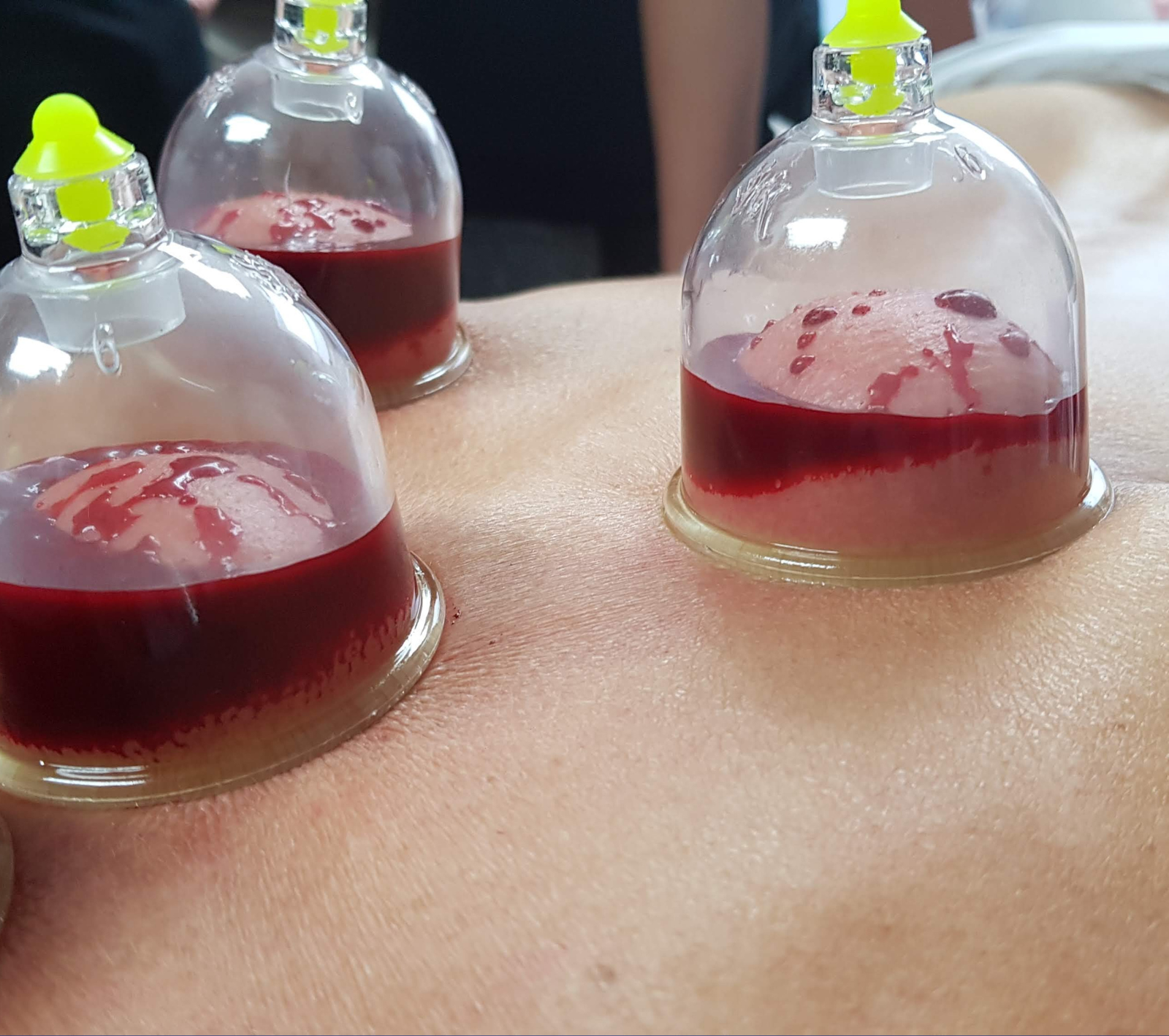 Wet Cupping in noida extension