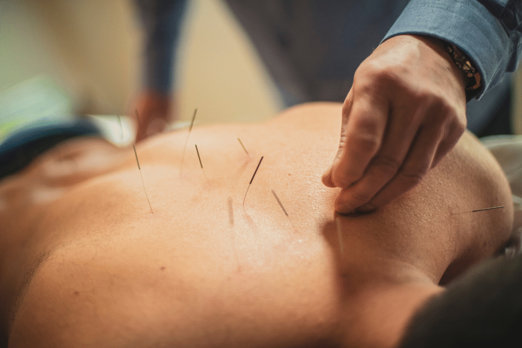 Acupuncture Therapy