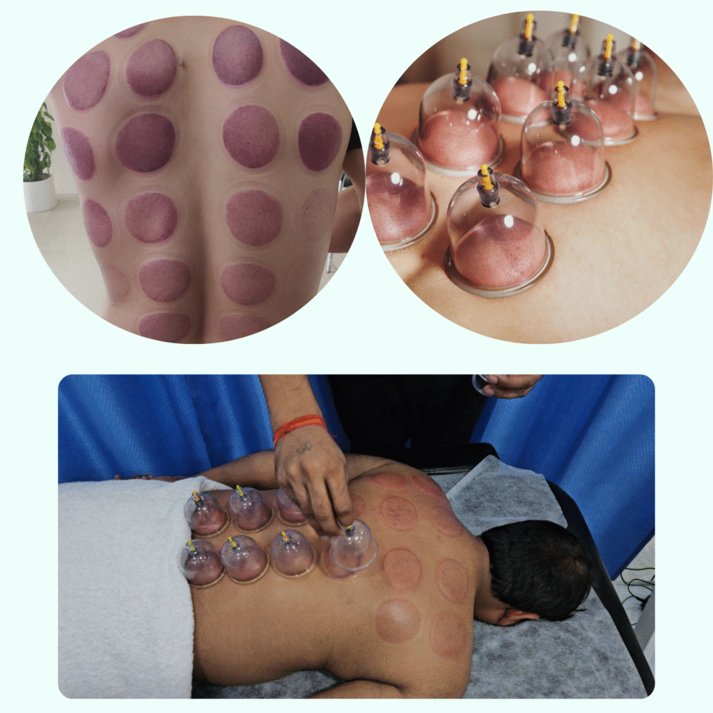 Cupping therapy Centre